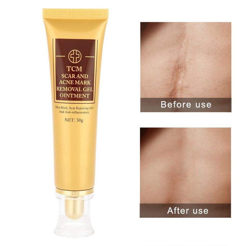 Acne Scar Removal Cream, Removal Ointment Gel Scar Marks Repair Skin Scre Natural Scar Repair Cream Acne Treatment Skin Brightening Lotion for Face and Body - BeesActive Australia