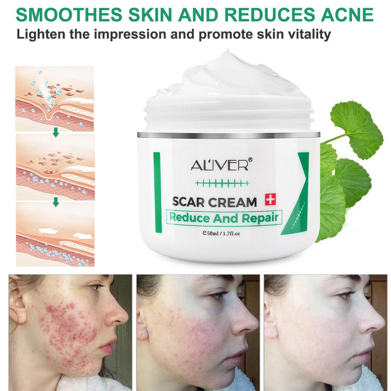 Scar Removal Cream 50G Scar Cream for Old New Scars Stretch Mark Removal Acne Spots and Burns Repair, Face Skin Repair Cream for Men & Women - BeesActive Australia