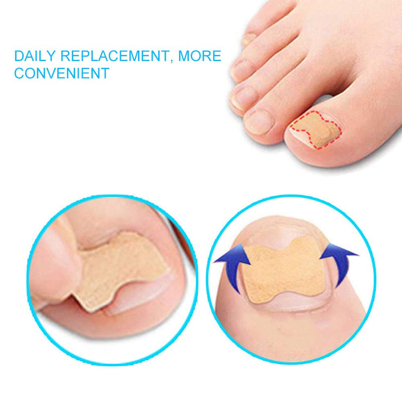 Mild Painless Toenail Correction Patch, Pedicure Ingrown Nail Corrector, Professional for Men Women Ingrown Nail Toenail Care Tool(48 pieces) 48 pieces - BeesActive Australia