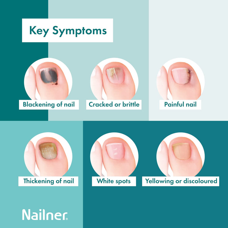 Nailner Fungal Nail Treatment Pen 4 ml - Extra Strong Anti Fungal Nail Treatment for Toenails - 2 in 1 Treat & Prevent Toe Nail Fungus - Antifungal Nail Infection - Clinically Tested & Fast Results Single - BeesActive Australia