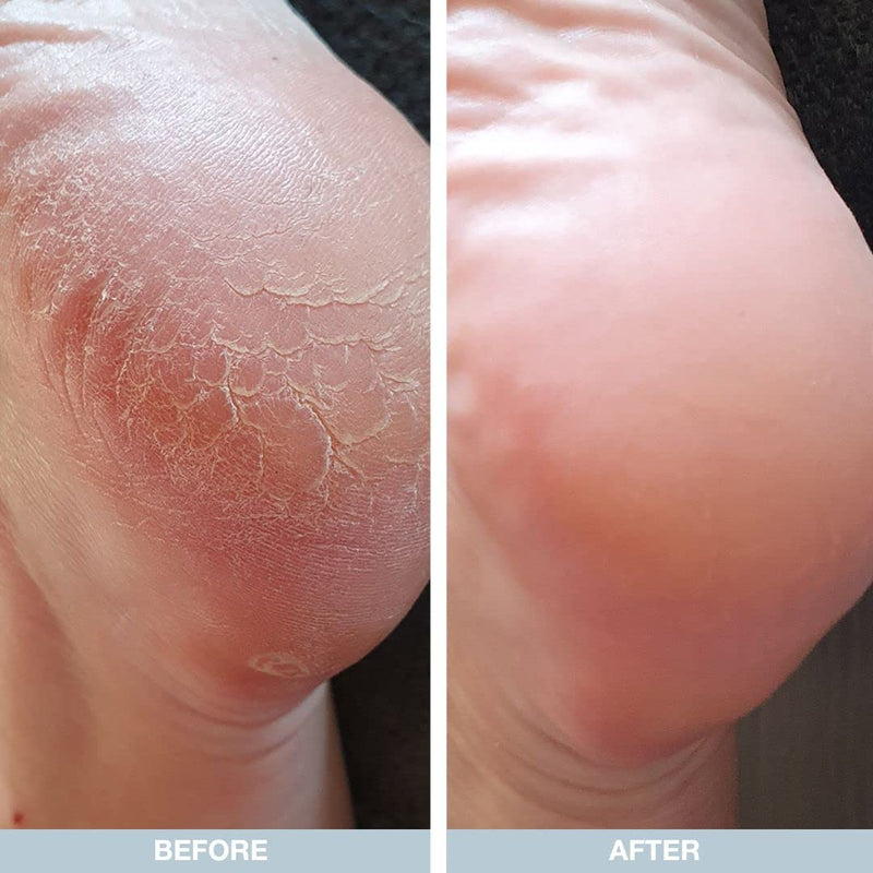 Australian Bodycare Cracked Heel Repair Cream 100ml | Hard Skin Remover for Feet | 25% Urea Cream | Cracked Heel Balm | Heel Care for Women & Men with Dry and Cracked Feet | Australian Tea Tree Oil 100 ml (Pack of 1) - BeesActive Australia
