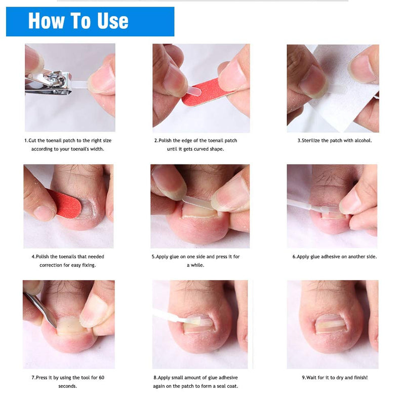 Rosvola Toe Ingrown Pedicure Straightening Sticker Clips 10Pcs/Box Toenail Correction Ingrown Sticker Patch Toe Nail Fixer Recover Pedicure Tool,Ingrown Toenail - BeesActive Australia