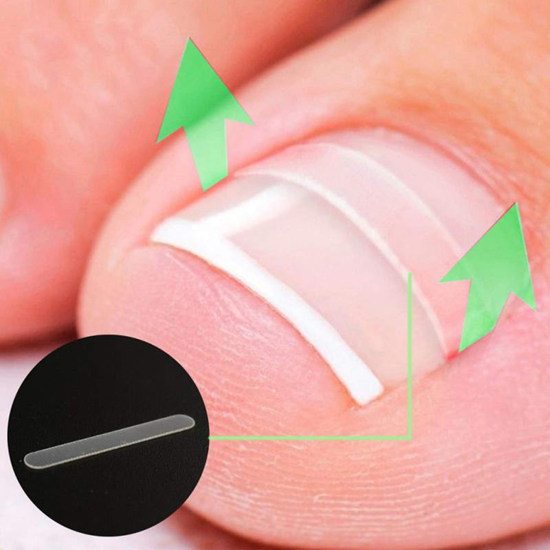 ONNPNN 50 Pieces Ingrown Toenail Correction Patches, Ingrown Toe Nail Treatment Tool, Curved Toenails Straightening Recover Clip, Thick Paronychia Correction Pedicure Tool - BeesActive Australia