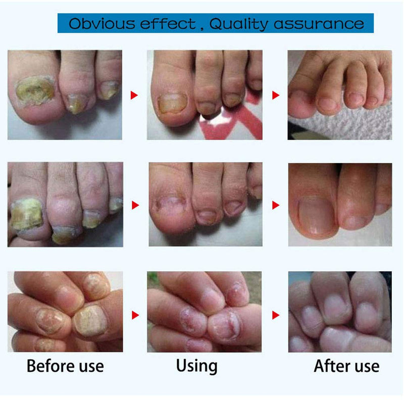 70pcs/box Toenail Correction Patch, Professional Ingrown Pedicure Foot Care Patch Portable Paronychia Corrector Ingrown Toe Nail Patch for Toenail Correction(#1) #1 - BeesActive Australia