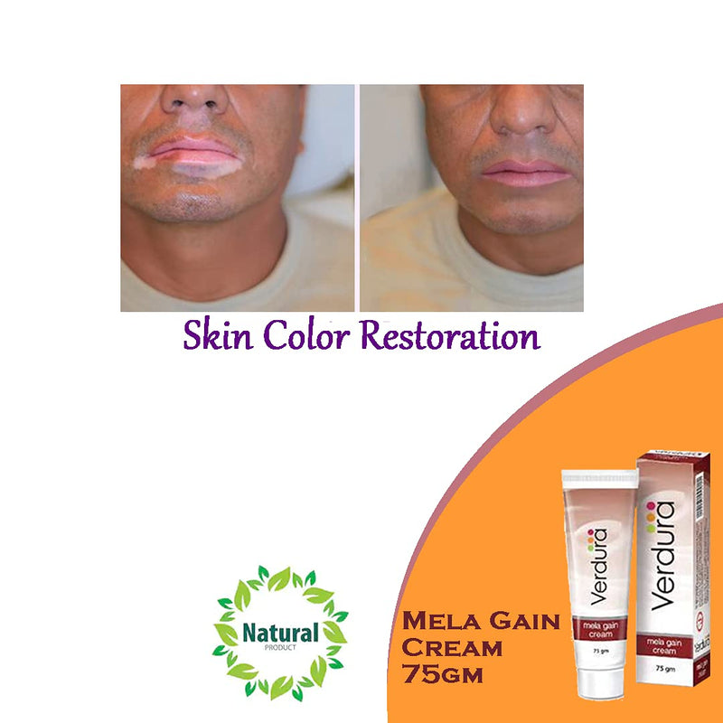 Herbal Aid Mela Gain Cream For Vitiligo And Hypo-Pigmentation White Spots Skin Care 75gm Cream Pack of 2 - BeesActive Australia
