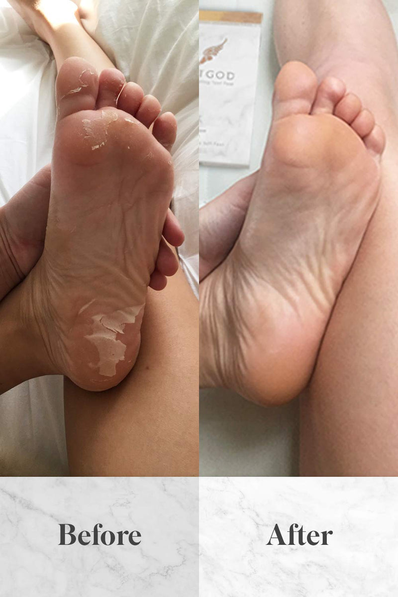 FootGod Exfoliating Foot Peel: Reveal Baby Smooth Feet, Moisturizing Aloe Gently Helps Peel Dead Skin, Eliminate Calluses with Luxury Skincare Technology - BeesActive Australia