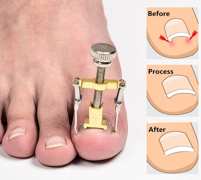 Ingrown Toenail Lifter Correction Tools Paronychia Toe Nail Treatment Corrector Recover Foot Nail Care Pedicure Tool with one pair of Toe Separators - BeesActive Australia