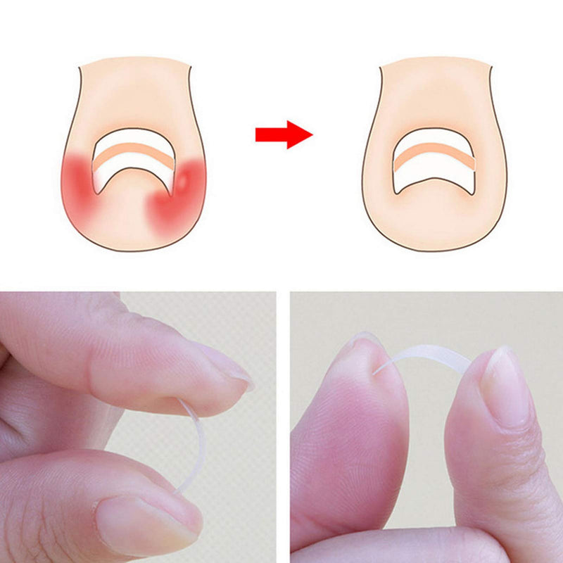 ONNPNN 50 Pieces Ingrown Toenail Correction Patches, Ingrown Toe Nail Treatment Tool, Curved Toenails Straightening Recover Clip, Thick Paronychia Correction Pedicure Tool - BeesActive Australia