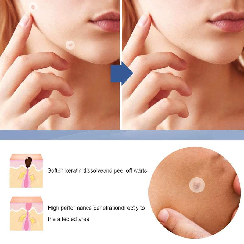 Mole Remover Patches,Skin Tag Removal Patches,Wart Healing Patches,Safe and Easy to Use in Minutes,144Pcs - BeesActive Australia