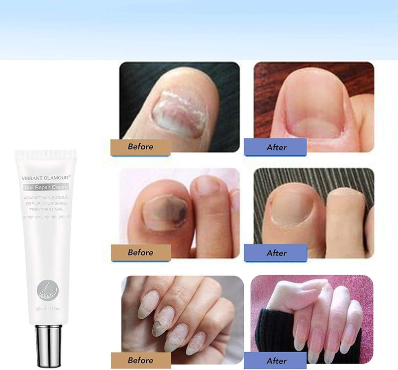 MISEDI 2 Pack Natural Nail Care Repair Cream Moisturizing Nail Treatment Onychomycosis Soften The Cuticle, Vibrant Glamour Nail Repair Cream - BeesActive Australia