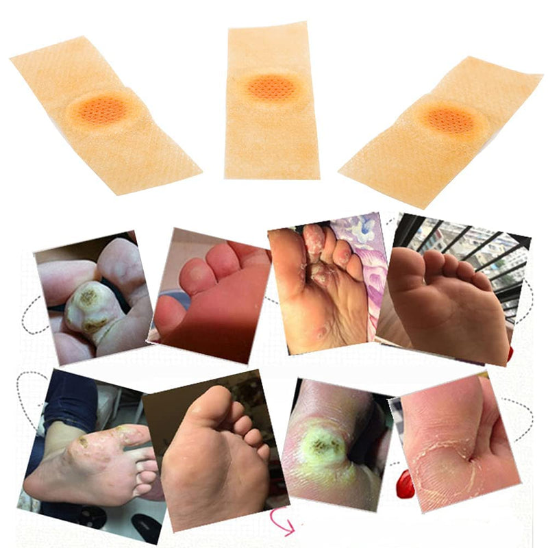 Wart Remover, Wart Remover Pads, Wart Treatment, Wart Remover for Hands, Feet, Feet Callus Remove, Verruca and Wart, Relief Pain Removal Warts Plaster, Soften Skin Cutting Sticker Toe Protector, 20 PC - BeesActive Australia