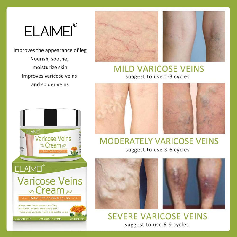 Varicose Veins Cream, Varicose Vein Soothing Leg Cream, Relief Phlebitis Vein Treatment Legs spider Veins Improves the Appearance of Leg Relieves Varicose Vein Discomfort Pain Strain - BeesActive Australia