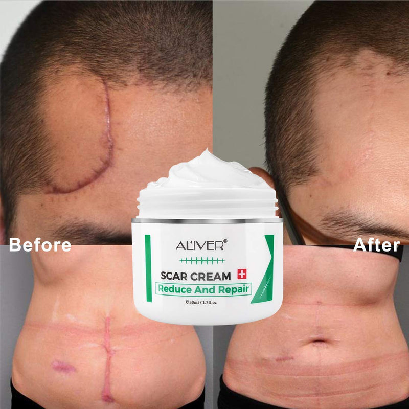 Scar Removal Cream, Scar Cream for Old & New Scars, Stretch Mark Remover, Acne Scar Removal, Body or Face Skin Repair Cream for Cuts,Surgery, Burn.Scar Treatment Cream, Skin Repair Gel for Men & Women - BeesActive Australia