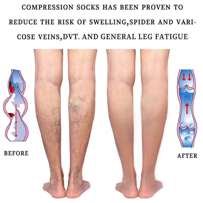 LIN PERFORMANCE 20-30 mmHg Compression Socks for Women and Men Knee High Open Toe Stockings for Varicose Vein Swollen legs (M,Rose Red) Rose Red Medium - BeesActive Australia