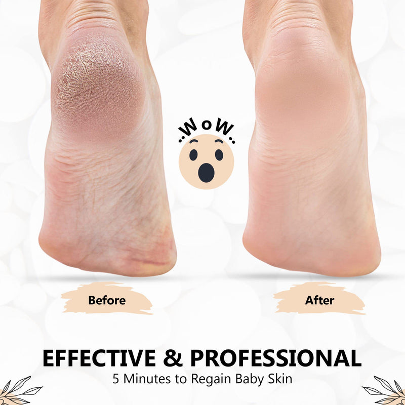 3 PCS Professional Pedicure Foot File for Hard Skin - Anti Rust Stainless Steel Callus Remover for Cracked Heels - Easy to Use & Anti Skid Design - Foot Care Tool for Dry and Dead Skin - BNS Classic Black - BeesActive Australia