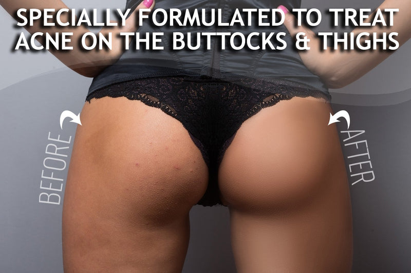 Anti-Acne Buttocks & Thigh Treatment- Clears Away Acne, Pimples, and Ingrown Hairs for the Buttocks and Thigh Area. Prevents Future Breakouts. - BeesActive Australia