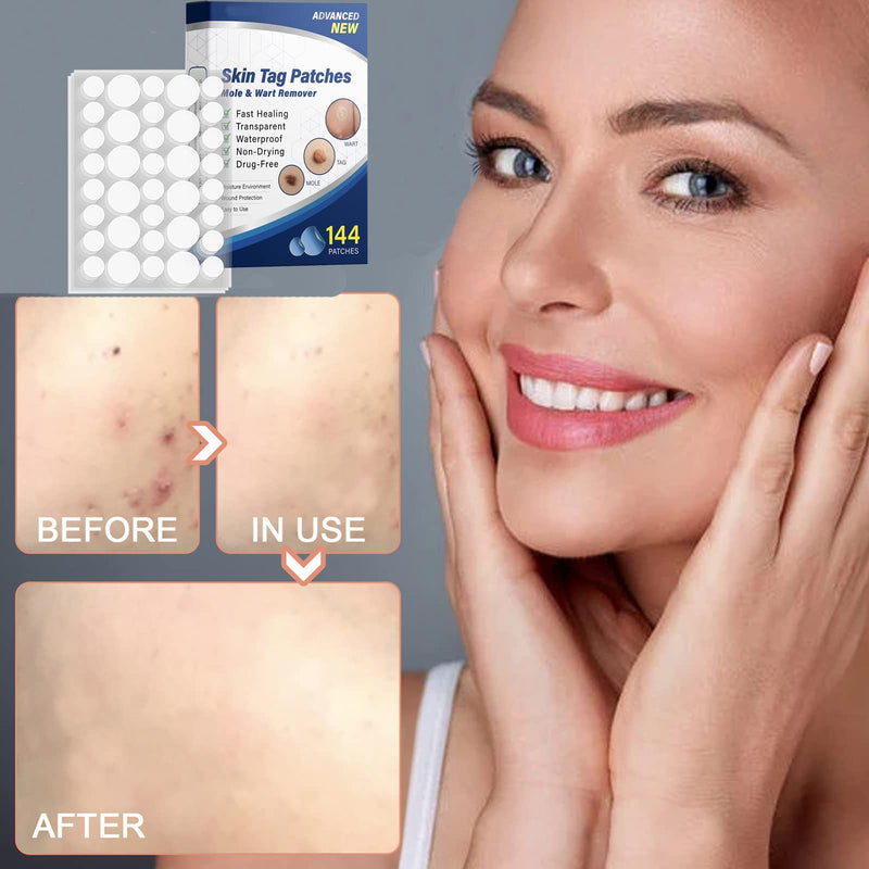 Mole Remover Patches,Skin Tag Removal Patches,Wart Healing Patches,Safe and Easy to Use in Minutes,144Pcs - BeesActive Australia