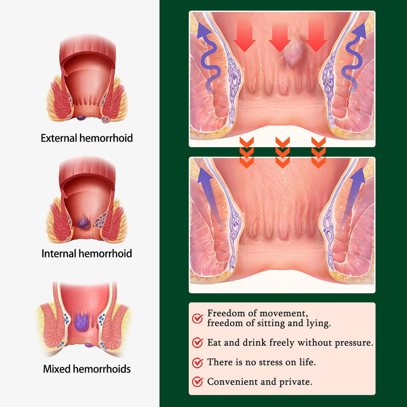 Hemorrhoid Ointment Treatment - Herbal Swelling Relief Hemorrhoid Fissure Ointment, 0.7oz - BeesActive Australia