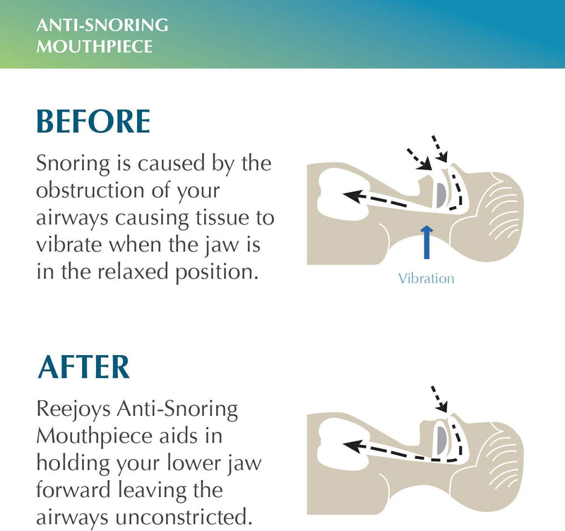 Anti Snoring Device Snore Stopper Mouthpiece, Stop Snoring Solution for Men and Women, Aid Custom Night Mouth Guard, 1 Pack - BeesActive Australia
