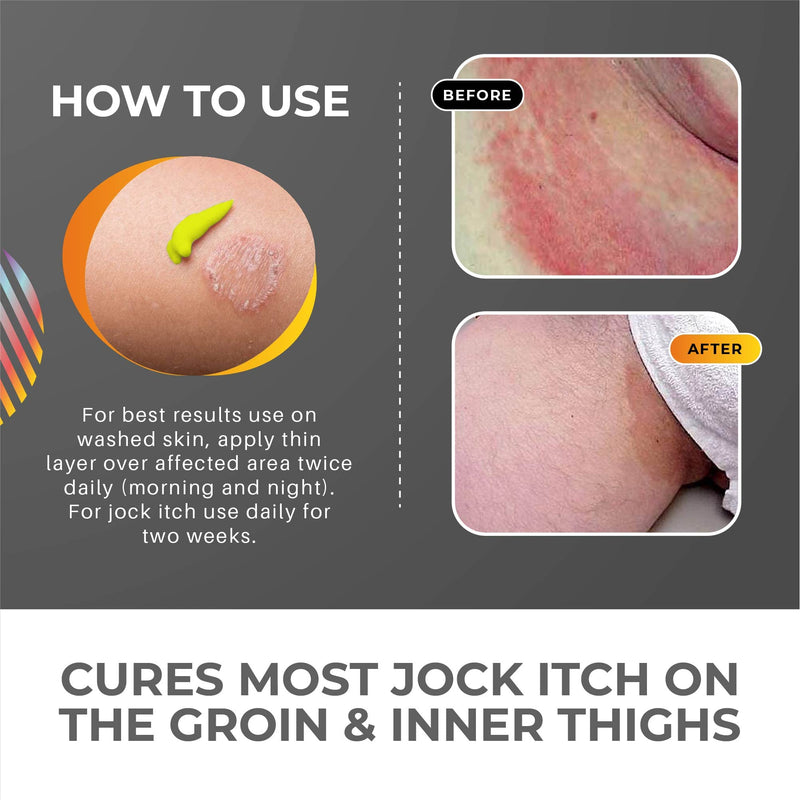 Jock Itch Treatment for Men & Women | Antifungal Cream | Skin Hero Jock Itch Treatment Antifungal | Supersize 50ml - BeesActive Australia