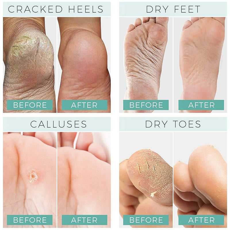 Foot Peel Mask - 2 Pack - For Cracked Heels, Dead Skin and Calluses - Make Your Feet Baby Soft Smooth Silky Skin - Removes Rough Heels, Dry Toe Skin Natural Treatment. (Rose Scent) - BeesActive Australia