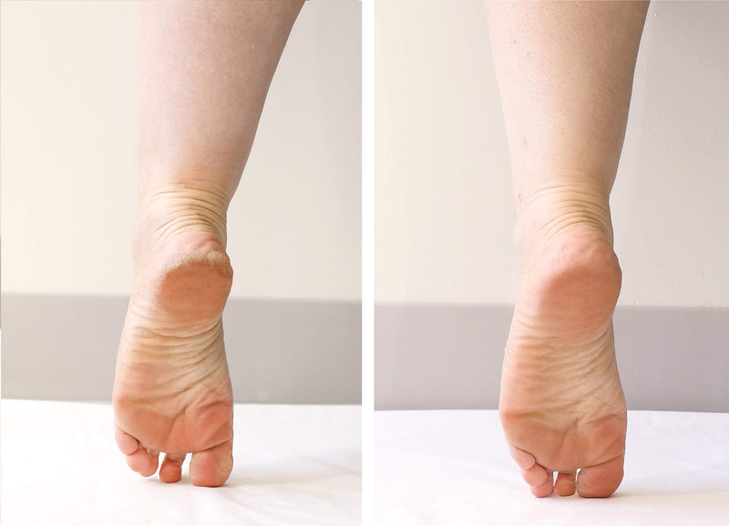 Patchology PoshPeel Pedi Cure Intensive Foot Peel Mask Treatment for Calloused Feet, 1 Pair - BeesActive Australia