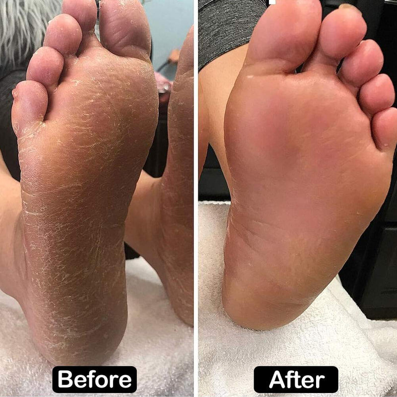 Electric Foot Callus Remover Adjustable Speed Electronic Hard Skin Remover Machine with 60pcs Replaceable Sandpaper Discs (Black) Black - BeesActive Australia