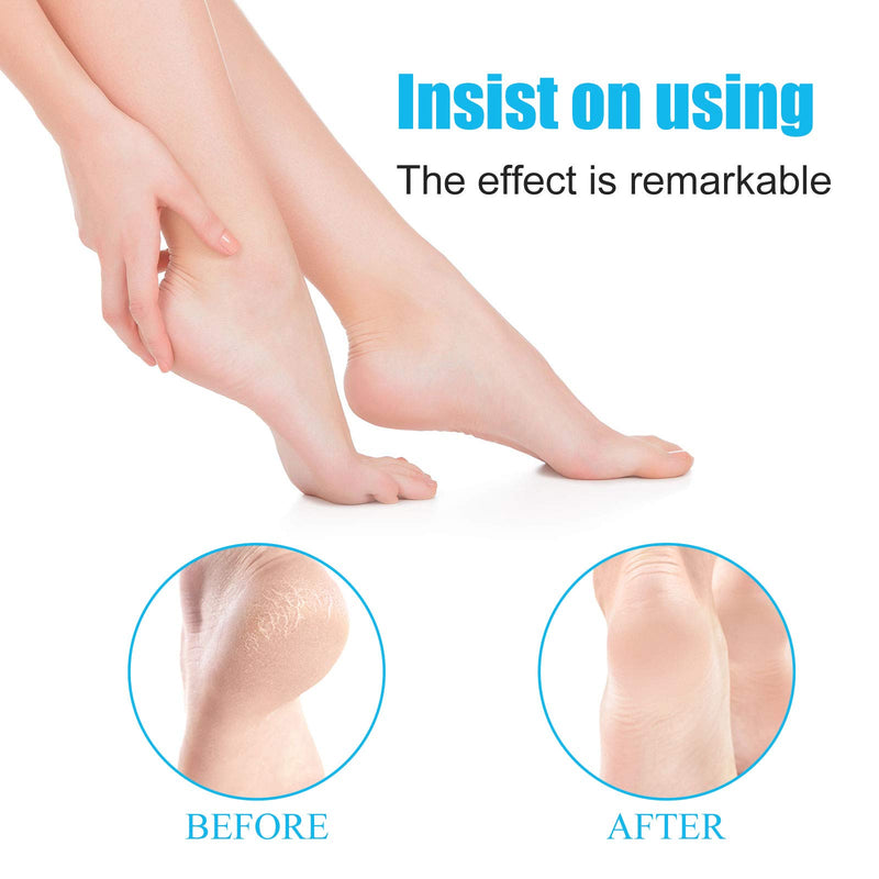 GEMAX Foot Scrubber Callus Remover,Professional Pedicure Kit Heel Scraper for Feet Dead Skin Removal, Cracking, Hard Cracked Dry Skin Removal, Wet and Dry Feet. - BeesActive Australia