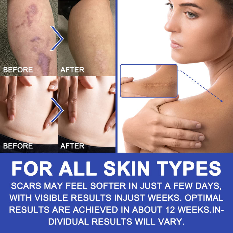Upgrade Silicone Scar Sheets, Clear Scar Tape | Silicone Scar Tape Roll | Silicone Scar Strips Reusable Effective Scar Removal Sheets for C-Section Surgery Scar Keloid Burn Acne (1.6" x 120", 3M) 1.6" x 120", 3M - BeesActive Australia