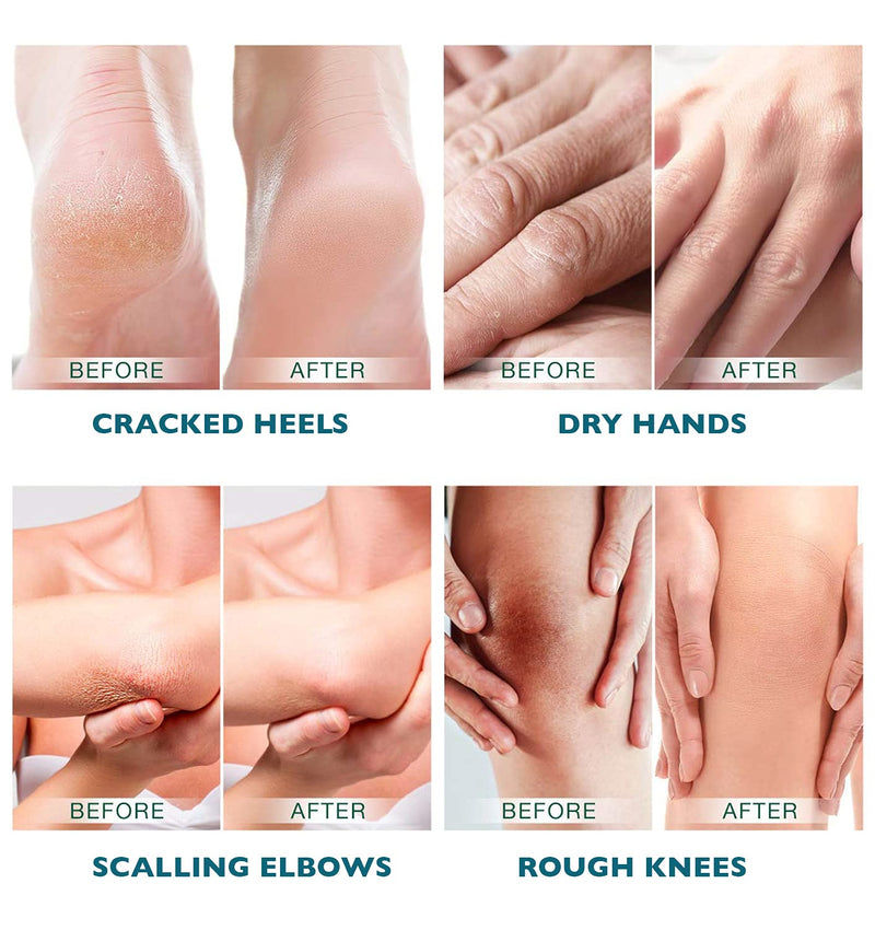 Urea 40% Cream 150g - best Callus Remover For Feet & Hands, Natural Moisturizes Nourishes Softens Dry, Rough, Cracked, Dead Skin - BeesActive Australia