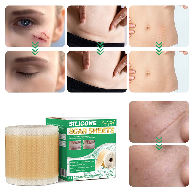 Silicone Scar Sheets (1.6” x 60”) Medical Soft Silicone Scar Tape for Scar Removal, Easy-Tear Silicone Tape Roll for Surgery Scars,Highly Comfortable Painless Easy Removal,Medical Grade Wound Dressing 1.6” x 60” - BeesActive Australia