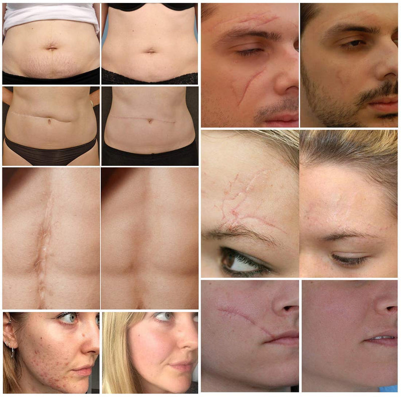 Scar Removal Cream, Scar Cream for Old & New Scars, Stretch Mark Remover, Acne Scar Removal, Body or Face Skin Repair Cream for Cuts,Surgery, Burn.Scar Treatment Cream, Skin Repair Gel for Men & Women - BeesActive Australia