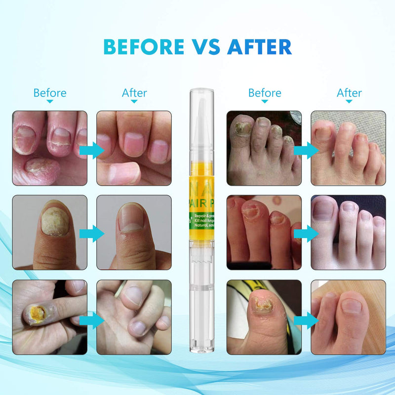 4pcs Nail Repair Pen, Nail Treatments, Repair Strengthen Toenails and Fingernails - BeesActive Australia