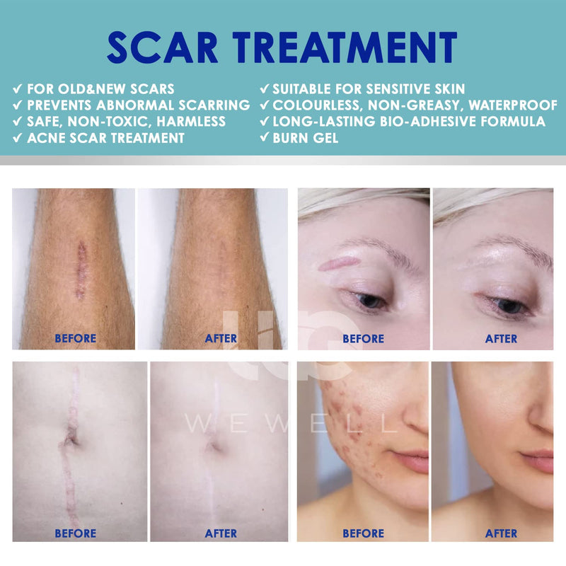 Wewell Medical-Grade Silicone Scar Gel, Advanced Scar Gel for Face Body, Scar Gel Effective for Both Old and New Scars - BeesActive Australia