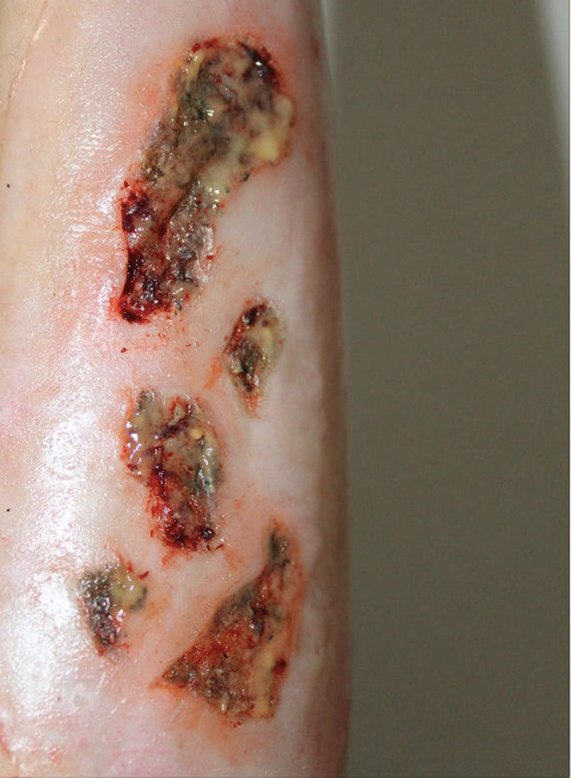 Forensic FX Infected Wound + Synthetic Pus Pre-Colored Silicone Prosthetic Appliance, Special Effects Makeup for Halloween and Theater Colored Prosthetic - BeesActive Australia