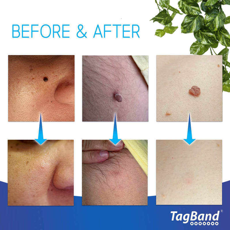 Auto TagBand Skin Tag Removal Kit. Fast Effective & Safe Skin Tag Remover for Small/Medium Skintags (2mm-4mm) on Face & Hard to Reach Areas - One-Hand Application in Minutes, Includes Pen + 10 Bands Small (2mm-4mm) - BeesActive Australia