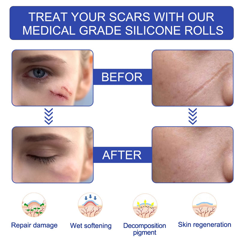 Upgrade Silicone Scar Sheets, Clear Scar Tape | Silicone Scar Tape Roll | Silicone Scar Strips Reusable Effective Scar Removal Sheets for C-Section Surgery Scar Keloid Burn Acne (1.6" x 120", 3M) 1.6" x 120", 3M - BeesActive Australia