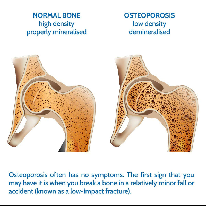 Densiboost Bone Remineralisation 60 Capsules (not Tablets) with Calcium, Magnesium, Manganese, Phosphorus, Copper, Boron, Zinc and Vitamins D3 and K2 MK-7. Made in The UK by Health4All 60 Count (Pack of 1) - BeesActive Australia