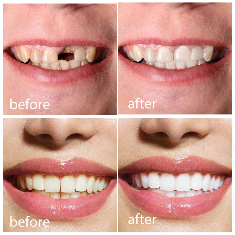 Temporary Tooth Replacement Thermal Adhesive Fitting Beads for Fake Teeth for Snap On Instant and Denture Adhesive Fake Teeth Cosmetic Braces Veneer - BeesActive Australia