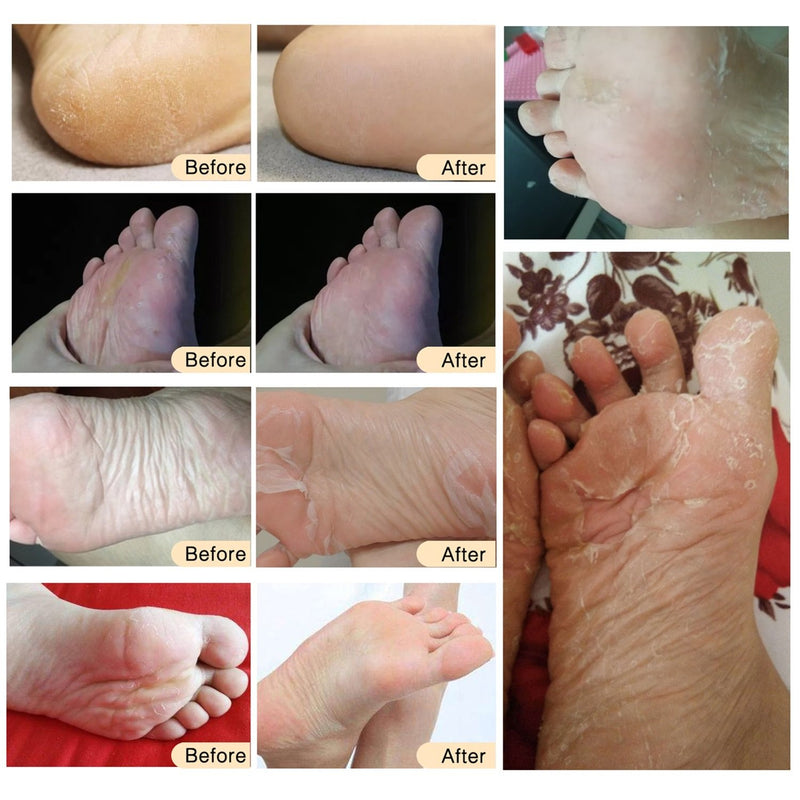 Foot Peel Mask (3 Pack), Exfoliating Foot Peel Mask for Cracked Heels, Dead Skin and Calluses, Repairs Rough Heels(Lavender) - BeesActive Australia