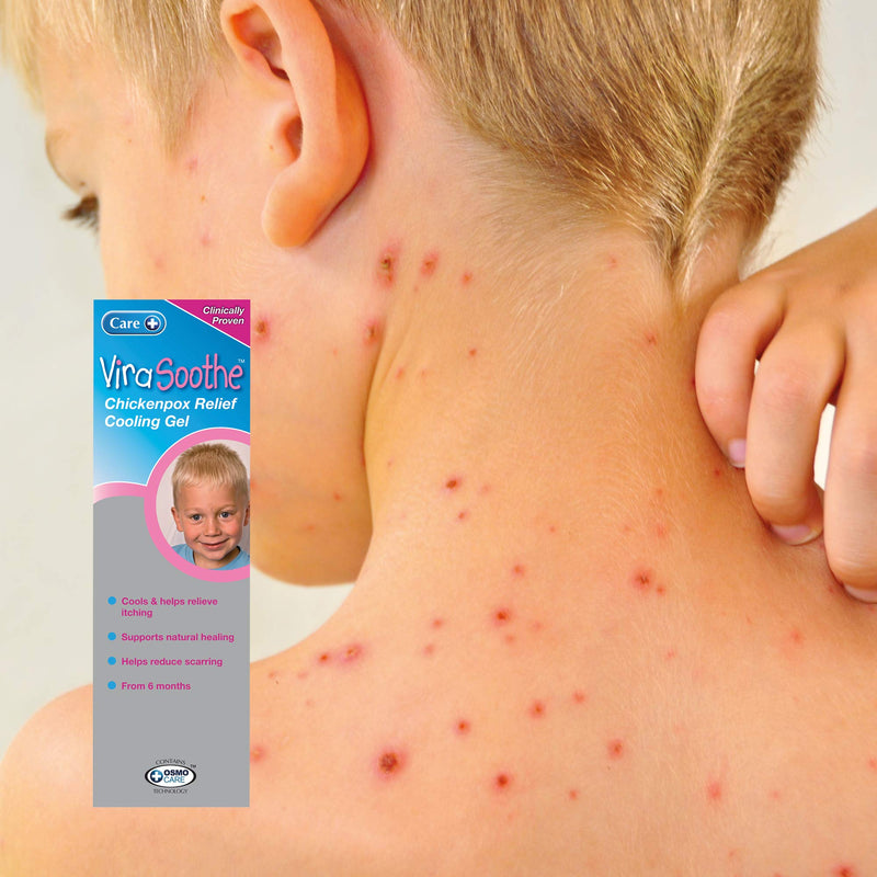 Care ViraSoothe Chickenpox Relief Cooling Gel 75g, Cools and Soothes Skin 75 g (Pack of 1) - BeesActive Australia