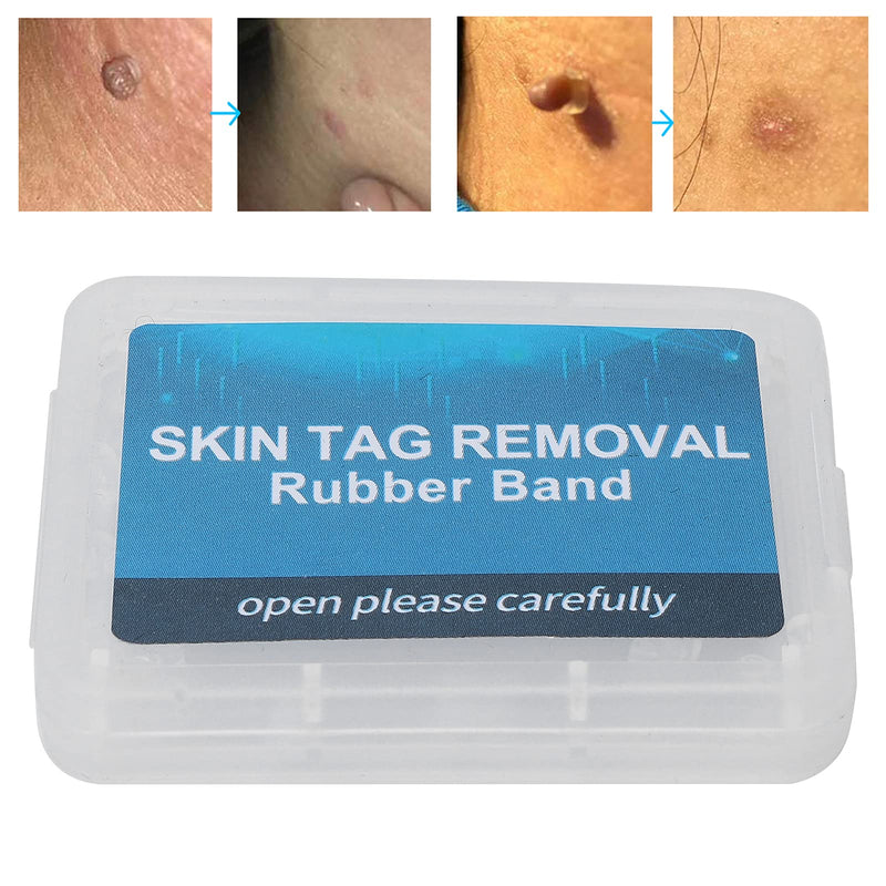 Sonew 30Pcs Skin Tag Band, Non Toxic Safe Micro Skin Tag Removal Rubber Bands Mole Wart Skin Care Tools - BeesActive Australia