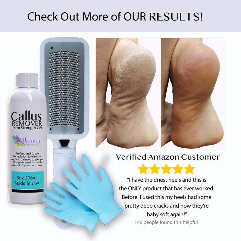 8oz Callus Remover Gel and Foot File/Foot Rasp Spa Kit. Professional Foot Care for dry, cracked heels. Soak in foot spa then apply callus gel to feet, and use foot scraper to peel off dead skin. - BeesActive Australia