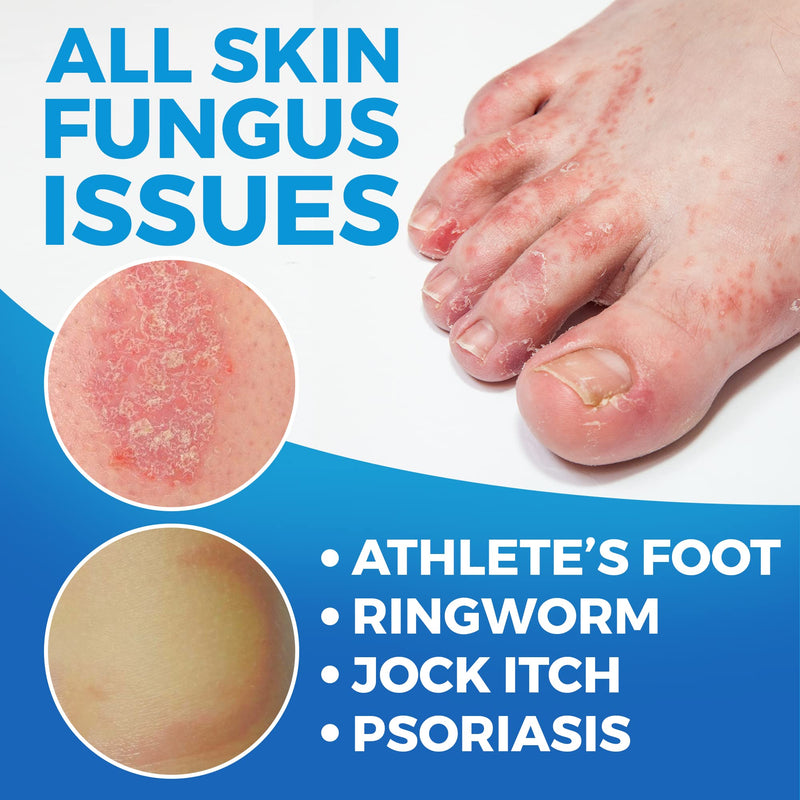 Extra Strong Athletes Foot Treatments Cream | Anti Itch Cream | Anti-Fungal Foot Treatment | Ringworm Foot Care | XL 75 ML - BeesActive Australia