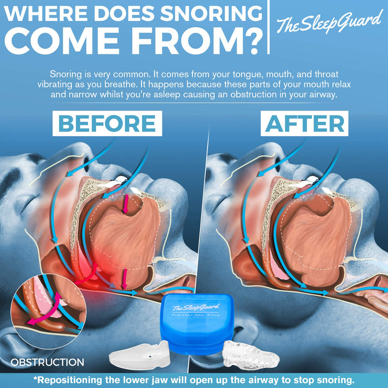 TheSleepGuard | Stop Snoring Solution Mouth Guard x1 | Sleep Aid and Snore Stopper | Best Anti Snoring Device, Mouthpiece & Gum Shield | Anti Snore Relief | Restful Sleep at Night for Men and Women - BeesActive Australia