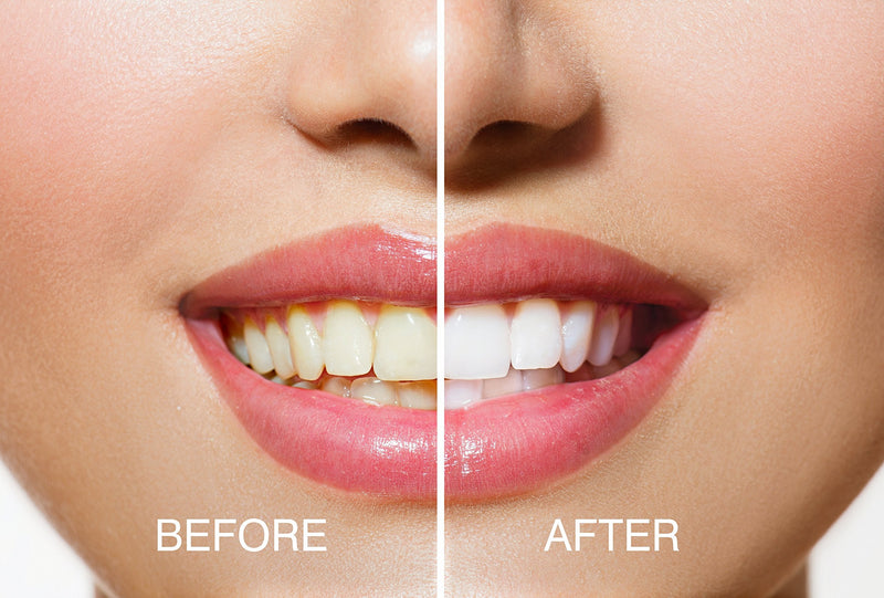 Rio Smile White Advanced Blue-Light Teeth Whitening Treatment - BeesActive Australia